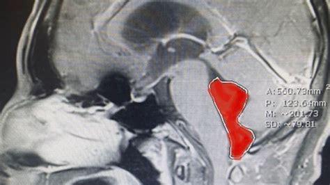 Texas Doctors Discover ‘rare Tapeworm In Mans Brain From Undercooked Pork Au