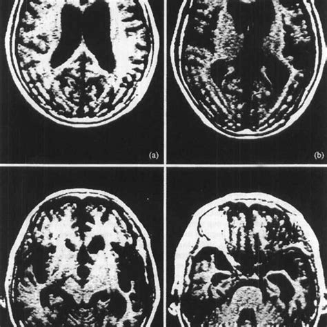 Four Sections From The Axial T Weighted Mri Scan For Nk Performed In