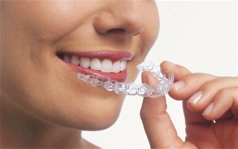 Exploring The Stages Of Invisalign Treatment