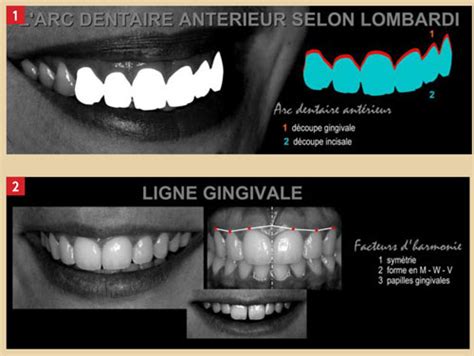 Les Critères De Lesthétique Dento Gingivale