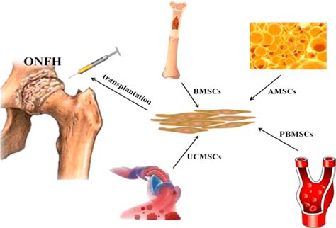 The Main Source Of Stem Cells For Transplantation ONFH Osteonecrosis