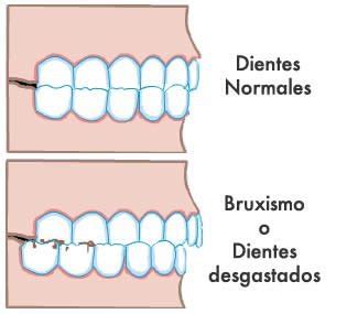 Bruxismo Causas S Ntomas Y Tratamiento Dentart