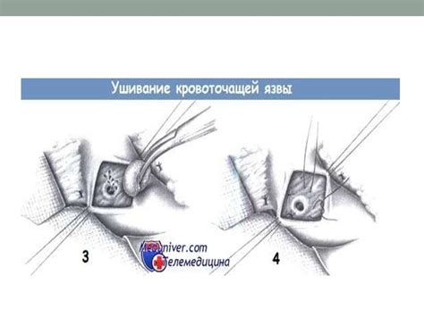 Принципы ушивания язв - online presentation