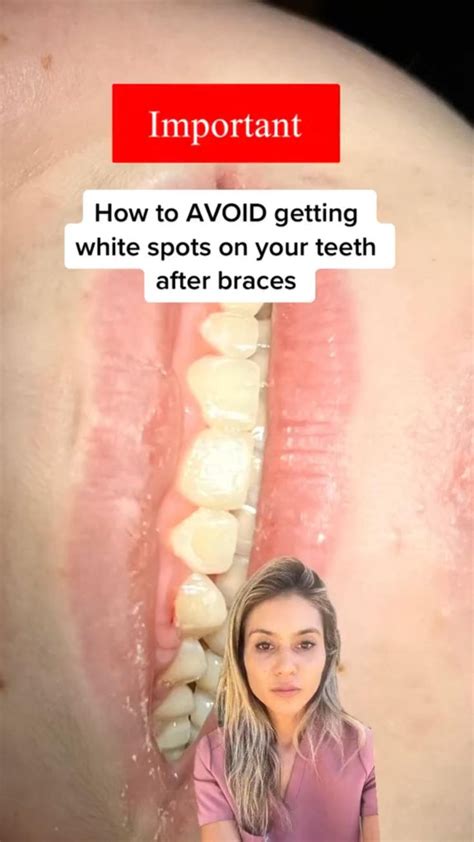 How To Avoid White Spots On Teeth After Braces Braces Braceson