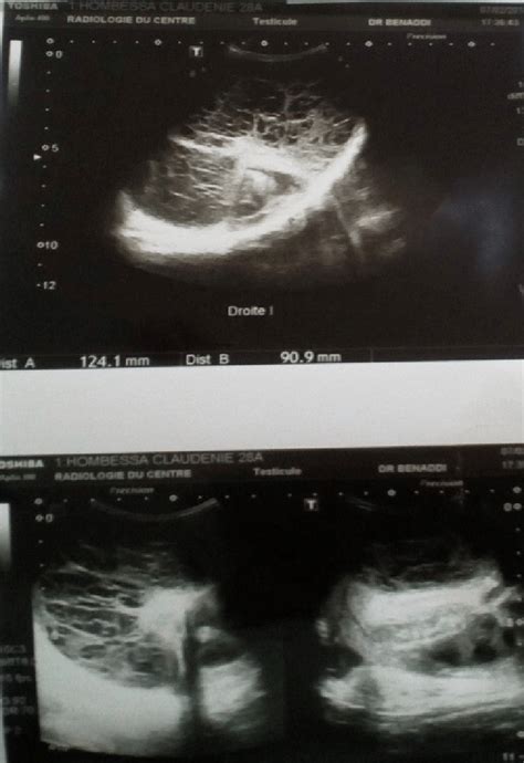 Scrotal Ultrasound With Doppler Showed A Swollen Enlarged Right