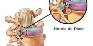 Cómo hacer ejercicio si tengo una hernia 8 pasos