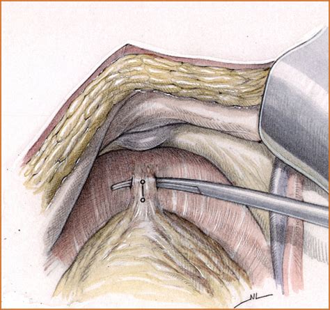 Radical Cystectomy And Orthotopic Bladder Replacement In Females