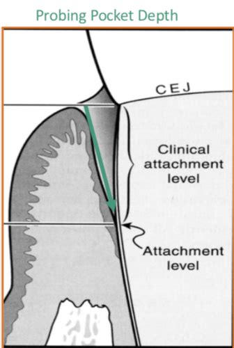 Perio Clinical Exam Radiographic Aids Flashcards Quizlet