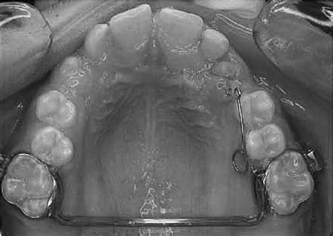 Transpalatal Arch With Spring Arm Download Scientific Diagram