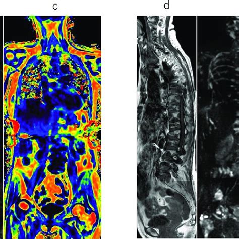 Whole Body Mri With A Diffuse Dominant Pattern Sagittal T1 Weighted