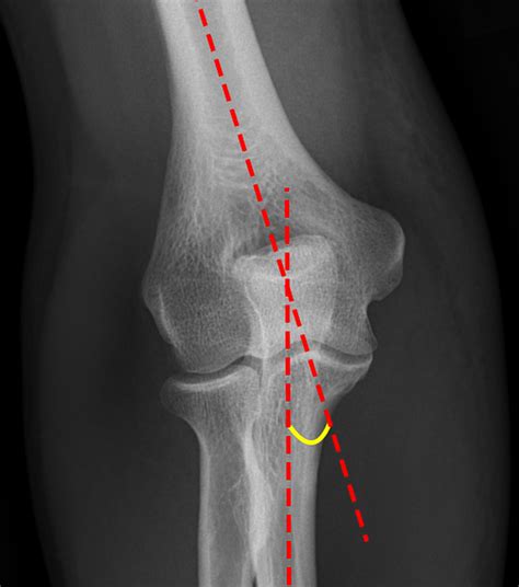 System for Reading Pediatric Elbow Xrays - Ortho Conditioning