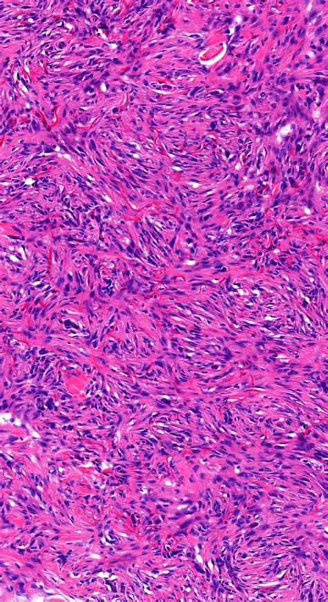 Granuloma Annulare Microscopic Images Pathology Disease Tissue