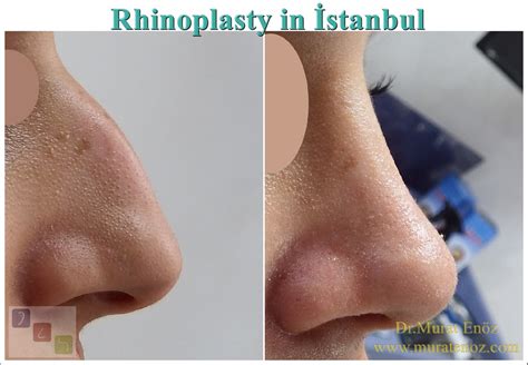 Health Zone Turkey There Are Many Reasons To Choose Istanbul For Nasal