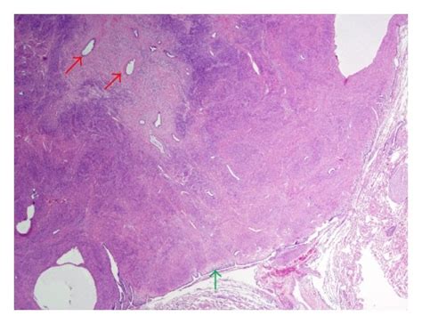 A A Well Circumscribed Tumor With A Pushing Border To The Lung