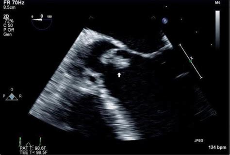 Tee Demonstrated A Large Aortic Valve Vegetation At Arrow And Severe Download Scientific