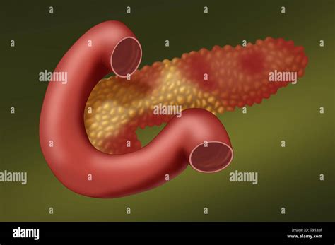 An Illustration Showing A Pancreas With Acute Pancreatitis