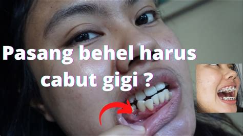 ALASAN GIGI GERAHAM AKU DI CABUT SEBELUM PASANG BEHEL CABUT GIGI