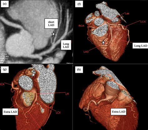 Normal And Variant Coronary Arterial And Venous Anatomy On, 40% OFF