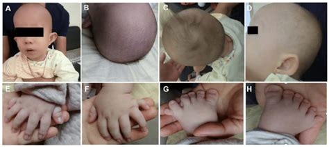 Macrocephaly In Infants