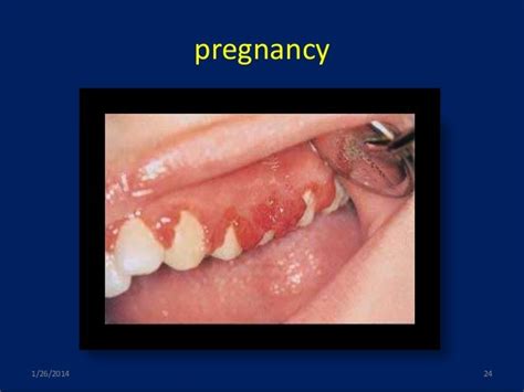 Gingival Enlargements