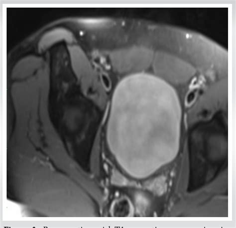 Figure 1 From Heterotopic Ossification Secondary To Motor Vehicle