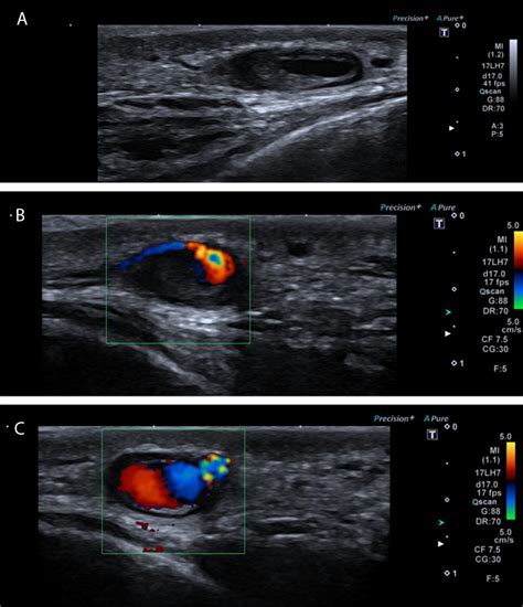 Temporal Artery Ultrasound