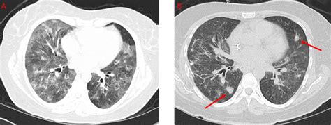 High Resolution Ct Histopathologic And Clinical Features Of Granulomatous Pneumocystis