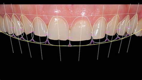 Benefits Of Digital Smile Design Dental Excellence Turkey Blog