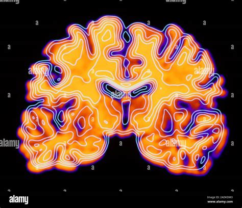 Brain Coloured Computed Tomography CT Scan Of A Section Through A