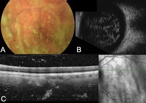 Asteroid Hyalosis An Update On Prevalence Risk Factors Emerging