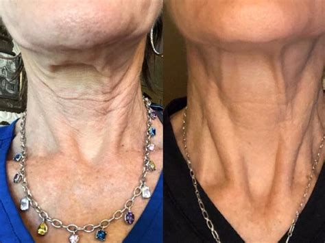 RF Microneedling Neck And Chest Smooth Synergy Medical Spa Laser Center