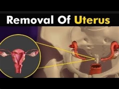 What Happenec In Hysterectomy Uterus Removal Surgery Animation Surgery