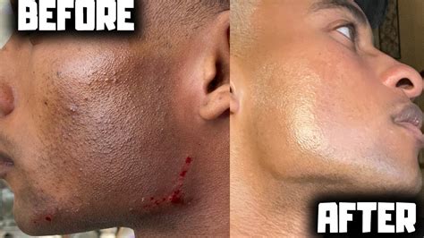 Laser Hair Removal For Men Before And After Why What And How Youtube