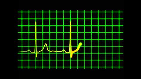 Irregular Heartbeat Youtube