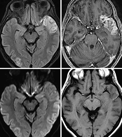 Subacute Infarction The Neurosurgical Atlas