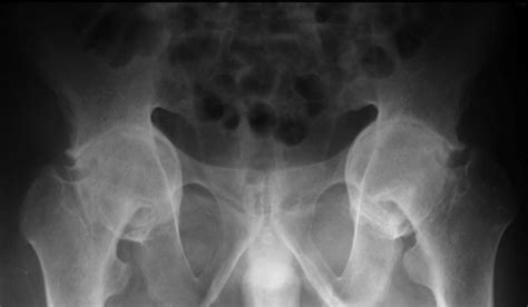 Acetabular Protrusio Bone Joint