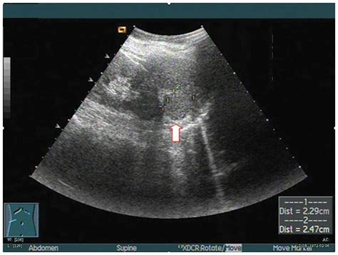 Rare Presentation Of A Right Retroperitoneal Accessory Spleen A Case