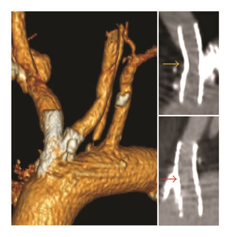 3 Month Ct Angiogram Demonstrates Excellent Dilatation Of The