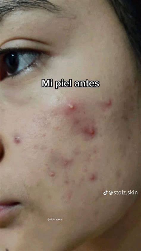 Pin De Rhiannon En Mascara Hacks Tiktok Recetas Para El Acne