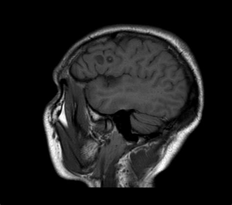 Neurocysticercosis Image Radiopaedia Org