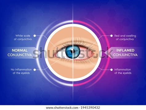 normal conjunctiva conjunctivitis human eye anatomy stock vector