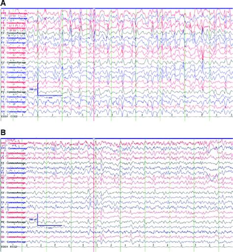 A Electroencephalogram Eeg Findings In Keeping With Non Convulsive