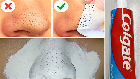 In Just 5 Mints Best Way To Remove Blackheads With Toothpaste Toothpaste For Remove Blackheads