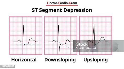 Ecg Morphology Of St Segment Depression Horizontal Upsloping And