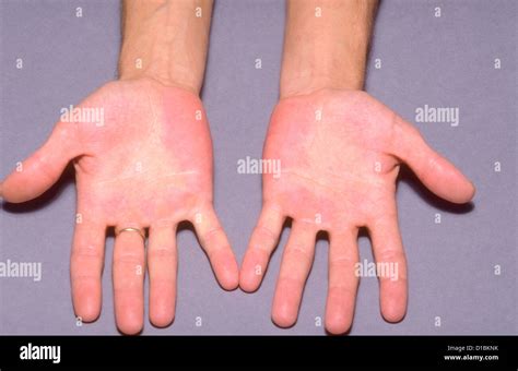 Palmar Erythema Stock Photo Alamy