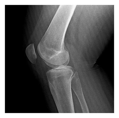 Preoperative Anteroposterior A And Lateral B X Rays And Axial