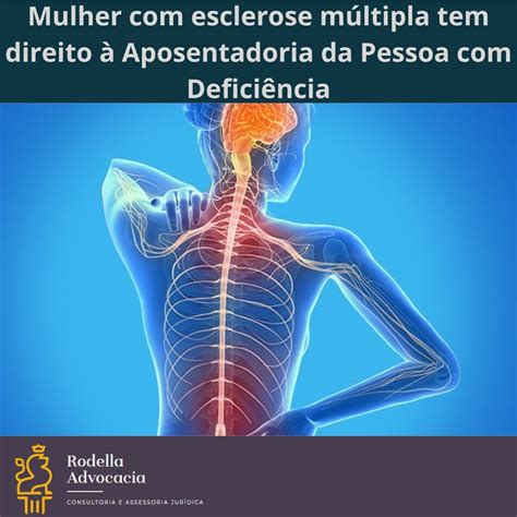 Mulher Esclerose M Ltipla Tem Direito Aposentadoria Da Pessoa