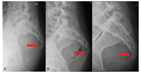 Coccyx Fracture Xray