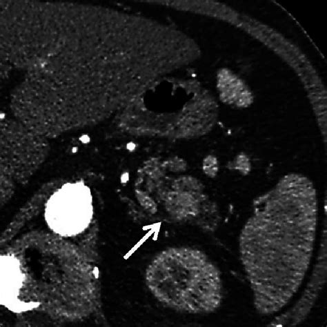 Histologic Staining Confirming An Intrapancreatic Spleen S Surrounded