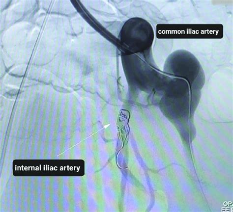 Angiographic Image Demonstrating Embolization With Fiber Coils In The